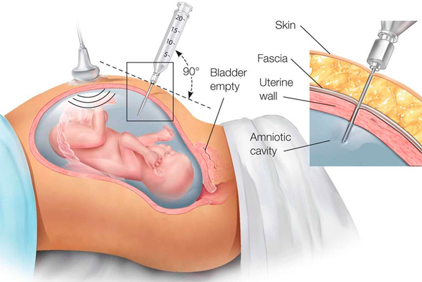 Amniocentesis semana - como funciona