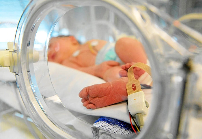 Patau sindrome niños Patau sindrome niños