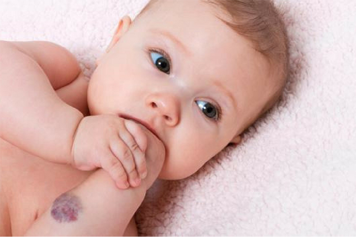 síndrome de Patau fotos imagenes síndrome de Patau fotos imagenes