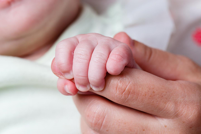 trisomía 13 en fotos trisomía 13 en fotos