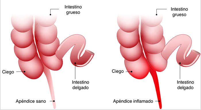 como se produce una apendicitis en niños