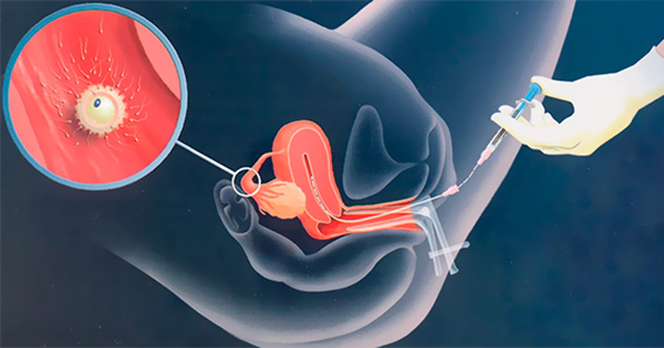 inseminación artificial proceso