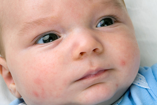 Traitement de l'acné néonatale
