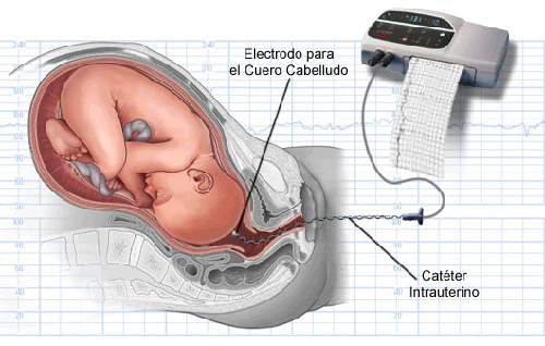 Monitor fetal parto