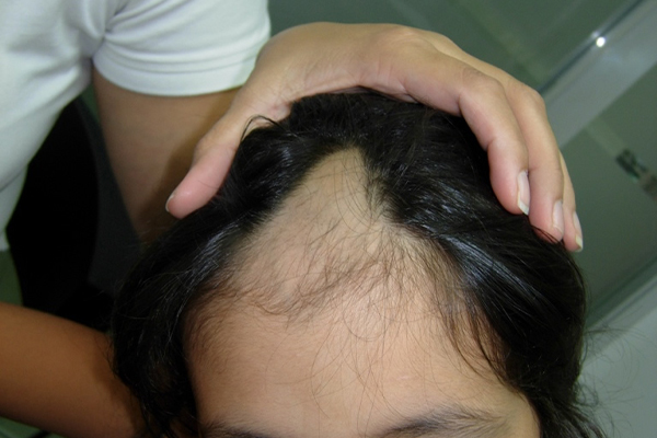 arrancarse el pelo por ansiedad